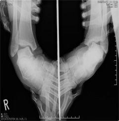 捻挫のレントゲン写真