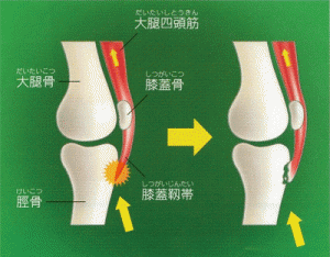 オスグット病のイメージイラスト