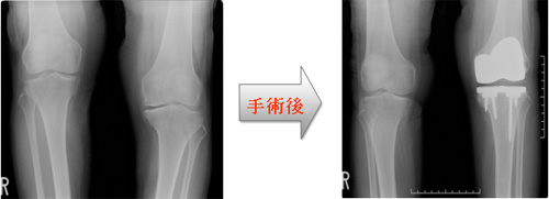 手術前後のレントゲン画像