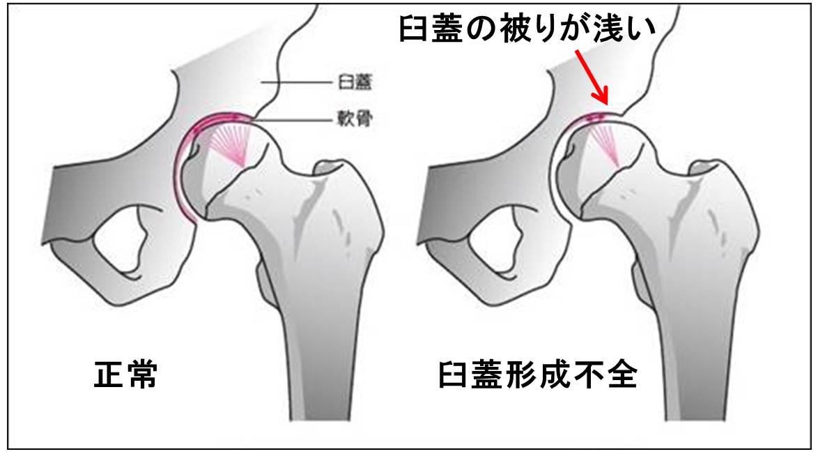 臼 不全 股関節 蓋 形成 臼蓋形成不全症 下肢関節の病気